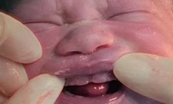 bebe-nasce-com-dentes